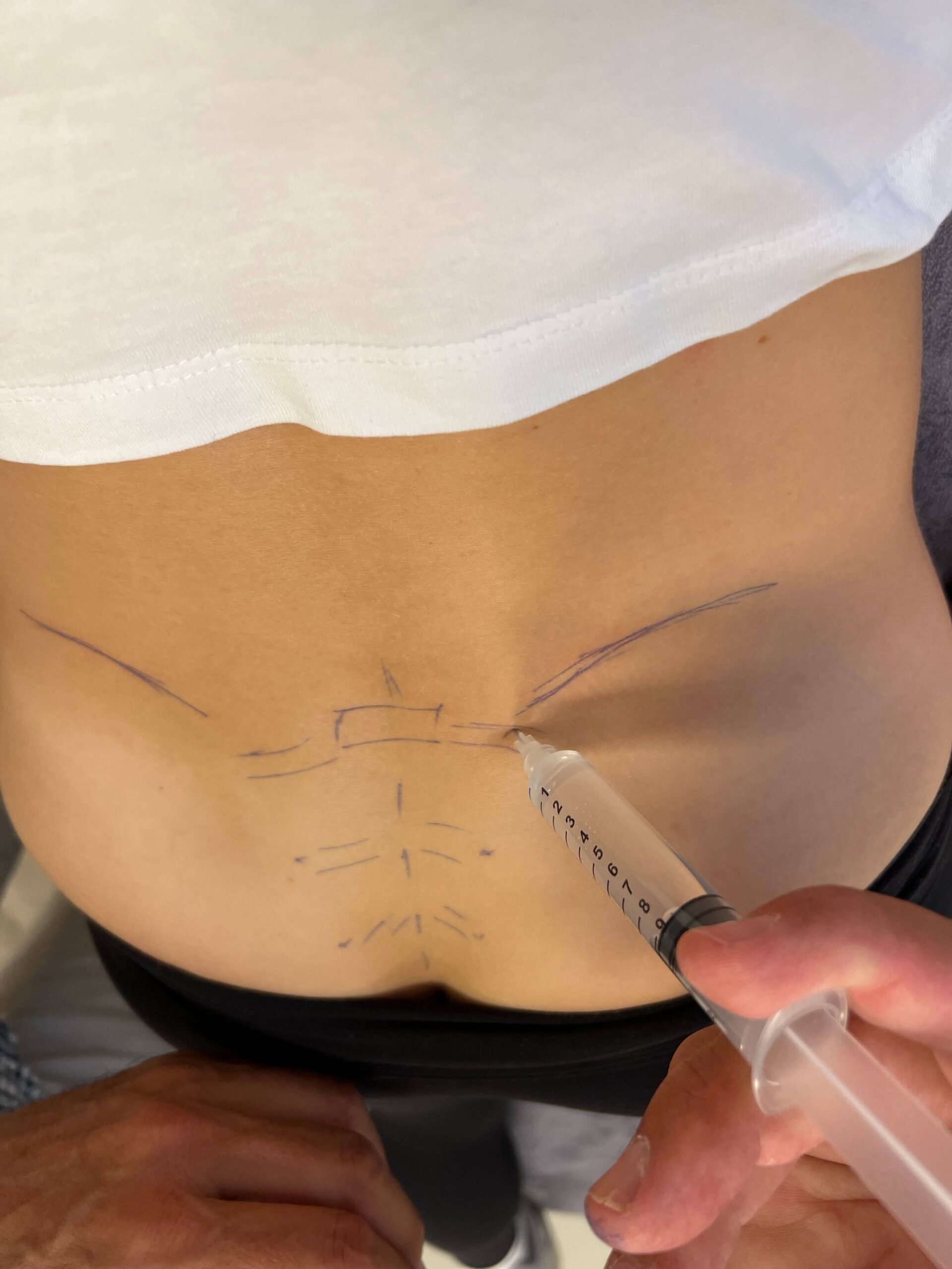 prolotherapie-behandeling